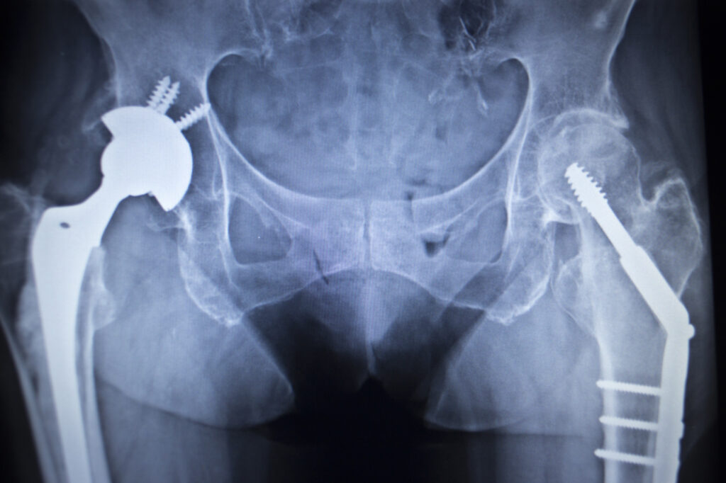 NuMRis: Automated Computational Tool to Study MRI RF Safety of Implanted Medical Devices - European Society of Cardiology (ESC Congress 2020)